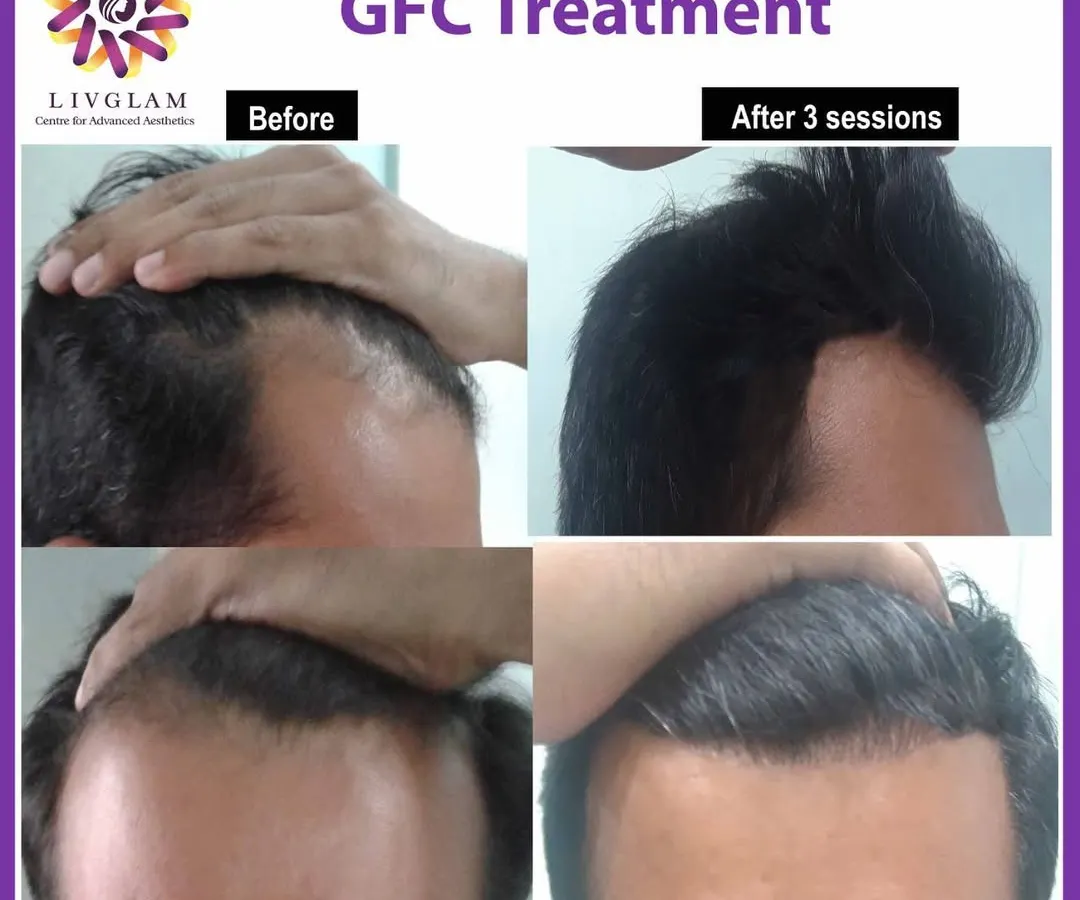 This client's hairline was restored after just three sessions of our non-surgical GFC treatment. Notice the significant increase in hair density and the natural-looking frontal coverage.