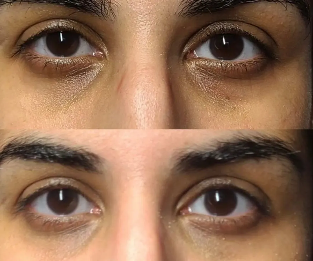A clear example of how my under-eye treatment works in just one session. This before-and-after shows a significant reduction in dark circles and hollows, making the eyes look instantly brighter and more rested.