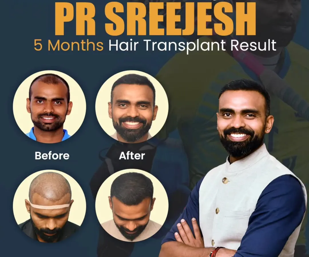 I had the honor of helping PR Sreejesh, the legendary Indian hockey player, restore his hair. This before-and-after collage shows his significant progress just 5 months into the journey, demonstrating how effective a well-planned transplant can be.