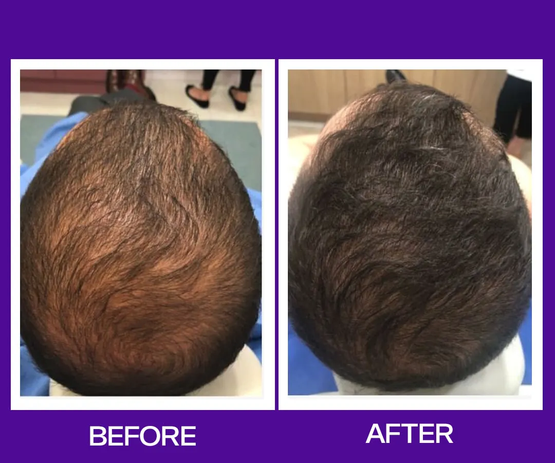 Don't let hair thinning affect your confidence. This before and after image shows the incredible results of our doctor-led hair regrowth treatments, helping you achieve visibly thicker and fuller hair.