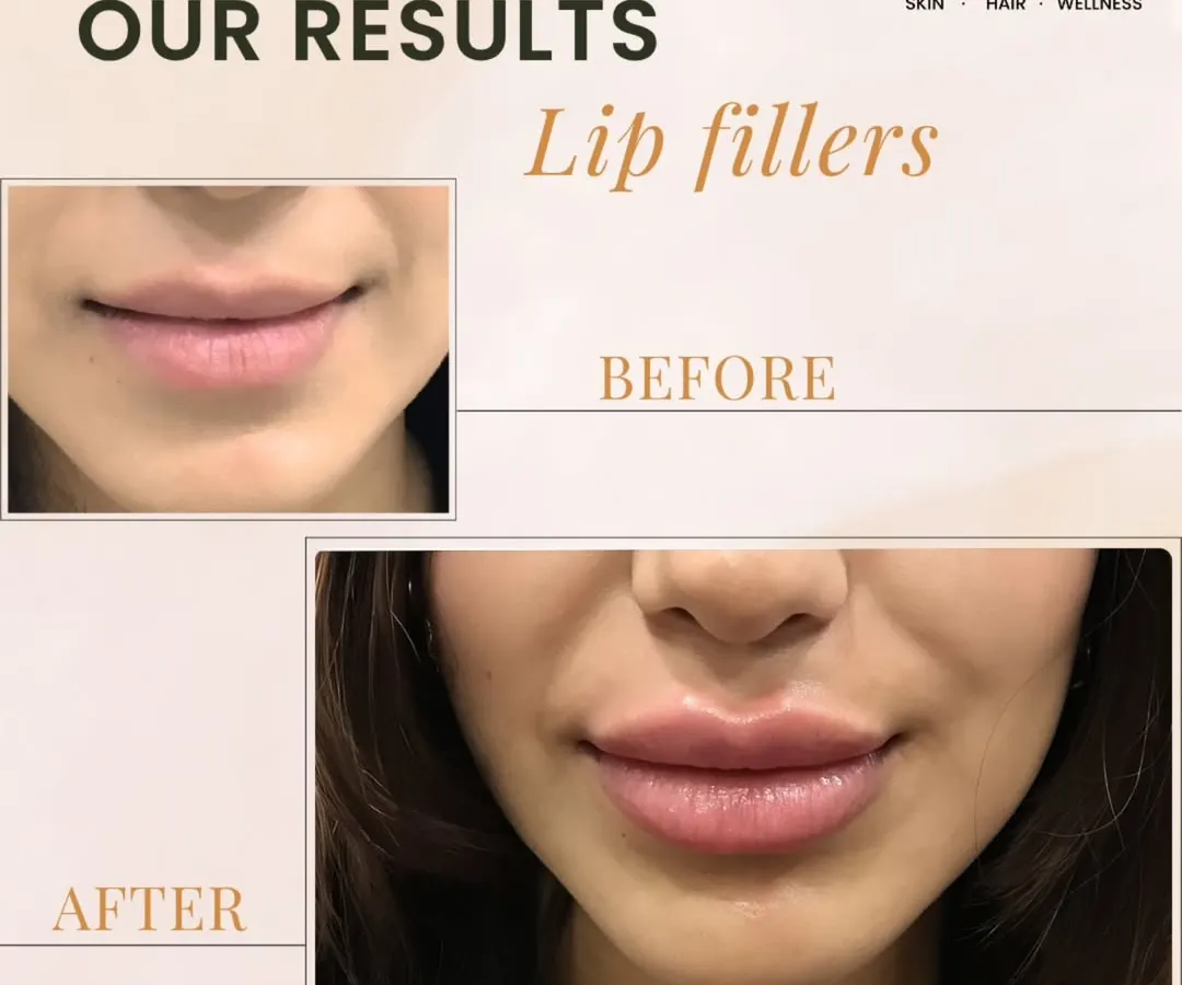This is a great example of our approach to lip fillers. We focus on enhancing the natural shape and restoring volume for a soft, beautifully balanced result that complements your features.