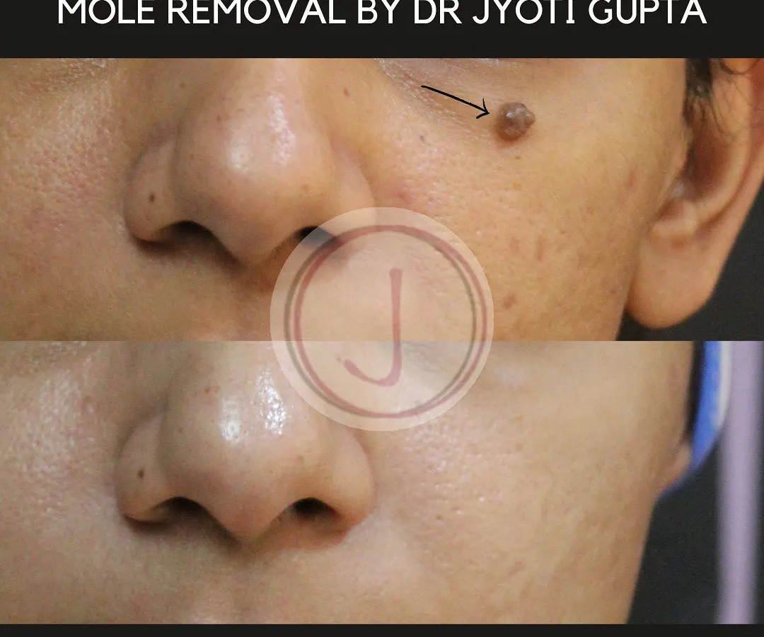 This before and after image shows a mole removal procedure using Radio Frequency Ablation. This technique allows for the precise and safe removal of benign moles with minimal scarring, providing a clean aesthetic result.