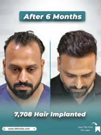 Hair Transplant Surgery