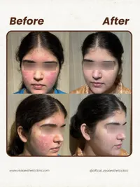 Acne & Scar Treatment