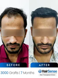 Hair Transplant & Restoration Surgery