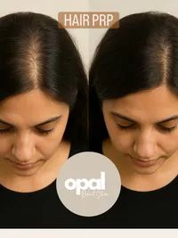 Hair Loss Treatment