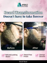 Facial Hair Transplant