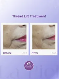 Advanced Anti-Aging & Facial Contouring