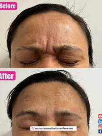 Cosmetic Injectables & Thread Lifts
