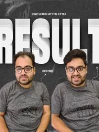 Non-Surgical Hair Replacement