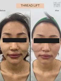 Anti-Aging & Facial Contouring