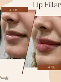 Anti-Aging & Facial Contouring