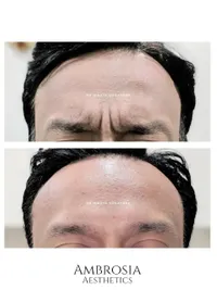 Anti-Aging & Facial Contouring