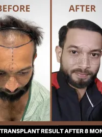 Hair Restoration and Treatment