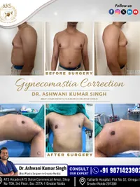 Breast Surgery