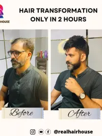 Non-Surgical Hair Replacement