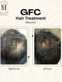 Hair Restoration