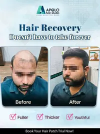 Non-Surgical Hair Replacement