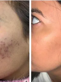 Pigmentation & Skin Tone Correction