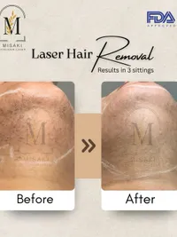 Laser Hair Removal