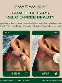 Wart, Skin Tag & Keloid Removal