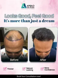 Hair Transplant