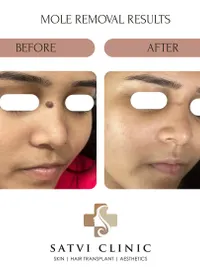 Mole & Wart Removal