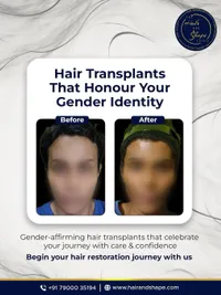 Gender-Affirming Hair Transplant