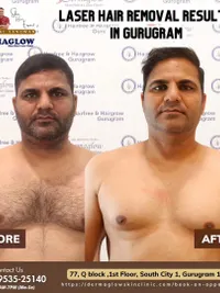 Laser Hair Removal