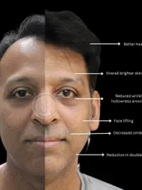 Hair Restoration