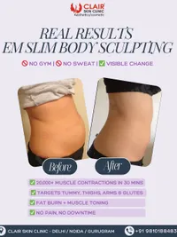 Non-Surgical Body Contouring