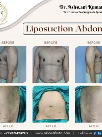 Body Contouring
