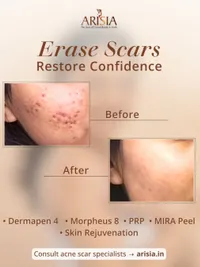 Acne, Scar & Pigmentation Correction