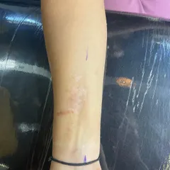 Before: A close-up of a scar on the client's wrist area, which they wanted to cover with a meaningful design.
