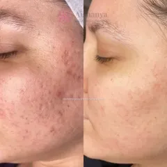 This before-and-after shows a remarkable improvement in both acne and post-inflammatory hyperpigmentation. A combination of treatments helped clear the breakouts and even out the skin tone, revealing healthier skin.