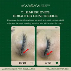 This before and after image shows the successful removal of colloid milia from the delicate eye area. This is a precise procedure that should only be performed by a professional to avoid scarring. My goal is always to provide safe, effective treatments that restore both skin health and patient confidence.