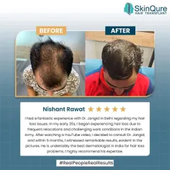 Real results speak louder than words. This is Nishant's story, who came to me with hair loss issues he faced while in the army. With a personalized non-surgical treatment plan, we achieved these remarkable results in just five months, significantly improving hair density and coverage.