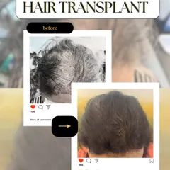 Hair loss is not just a male concern. We provide specialized FUE hair transplant procedures for women, focusing on restoring density and confidence with results that are both beautiful and natural.