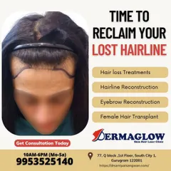 The first step in a successful transplant is designing the perfect hairline. We work with each client to draw a custom hairline that complements their facial structure, ensuring the final result is both natural and aesthetically pleasing.