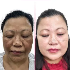 This before and after comparison highlights a dramatic improvement in facial pigmentation. The patient's skin on the left shows extensive dark spots and uneven tone, which is visibly lightened and clarified in the after photo, resulting in a radiant and healthier-looking complexion.