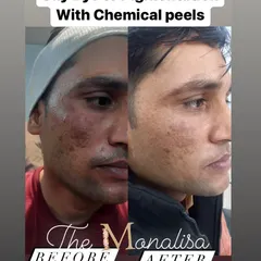 This before and after photo shows the effectiveness of our chemical peels in treating hyperpigmentation. We create tailored plans to significantly lighten dark patches and even out skin tone for a clearer complexion.