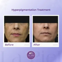 Hyperpigmentation can be a persistent concern, but our advanced treatments deliver visible results. This image shows a dramatic improvement in skin clarity and brightness, demonstrating the effectiveness of our personalized approach to correcting uneven skin tone.