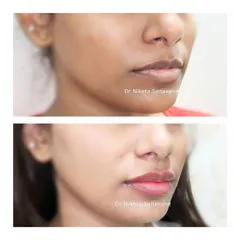 Another example of my natural approach to lip fillers. We enhanced the shape and plumpness of the lips while maintaining a result that complements the patient's features perfectly.