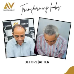 A clear example of restoring hair volume and coverage. The after photo shows a significant increase in density, creating a much fuller and healthier appearance.