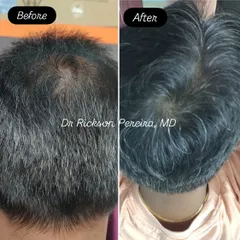 This view of the crown shows a remarkable increase in hair density after eight months of consistent treatment. This result underscores the importance of patient compliance and trusting the medical process.