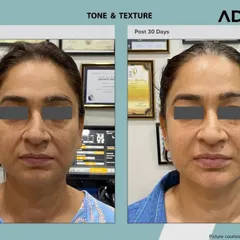 This frontal view shows the same patient's progress. The AdvaTx laser has effectively addressed widespread pigmentation and textural irregularities, resulting in a healthier and more youthful complexion.
