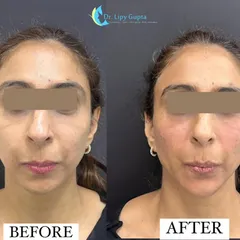 This before-and-after shows how under-eye fillers can make a significant difference. By carefully restoring lost volume in the tear trough area, I can reduce hollows and dark circles for a refreshed, well-rested appearance.