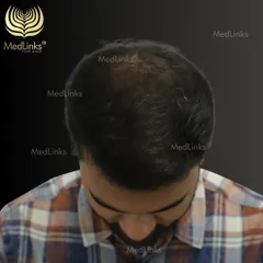 This client was experiencing significant thinning on the crown. Our hair transplant solution restored density and provided a natural, full look, completely transforming his appearance from the top.