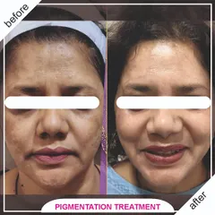 This before-and-after shows the successful treatment of hyperpigmentation and melasma. Our combination of US-FDA approved lasers and peels gives satisfying results in just a few sessions.