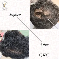 Another powerful GFC transformation. The arrows in the 'before' photo point to areas of significant thinning, which are visibly fuller and denser in the 'after' photo, demonstrating successful hair regeneration.